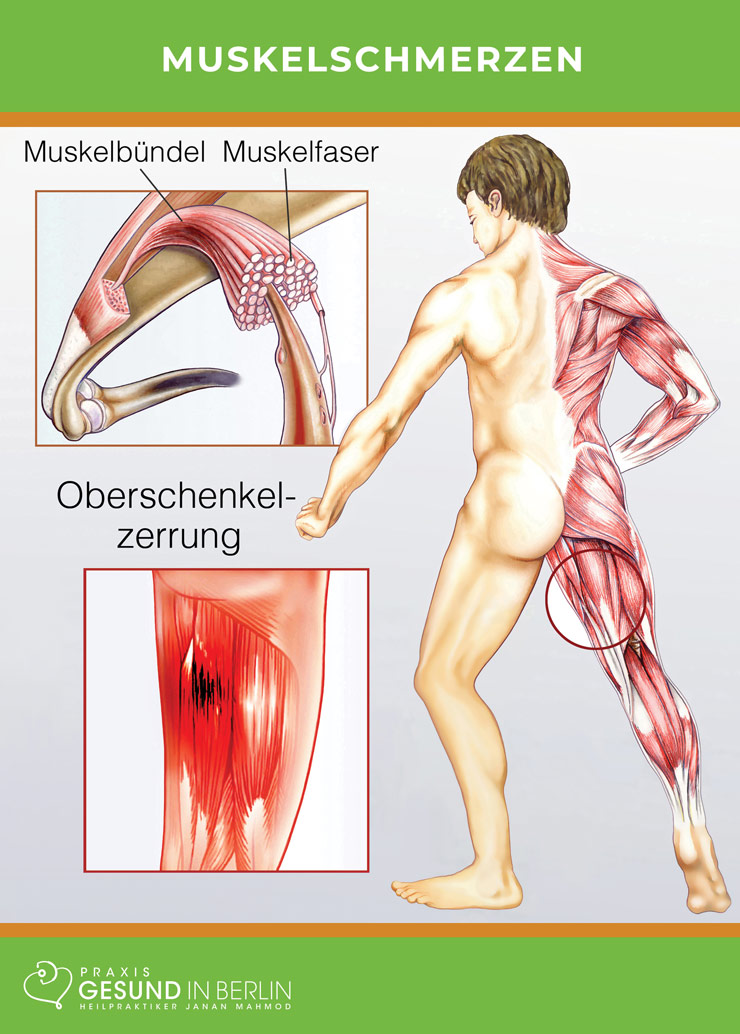 Muskelschmerzen
