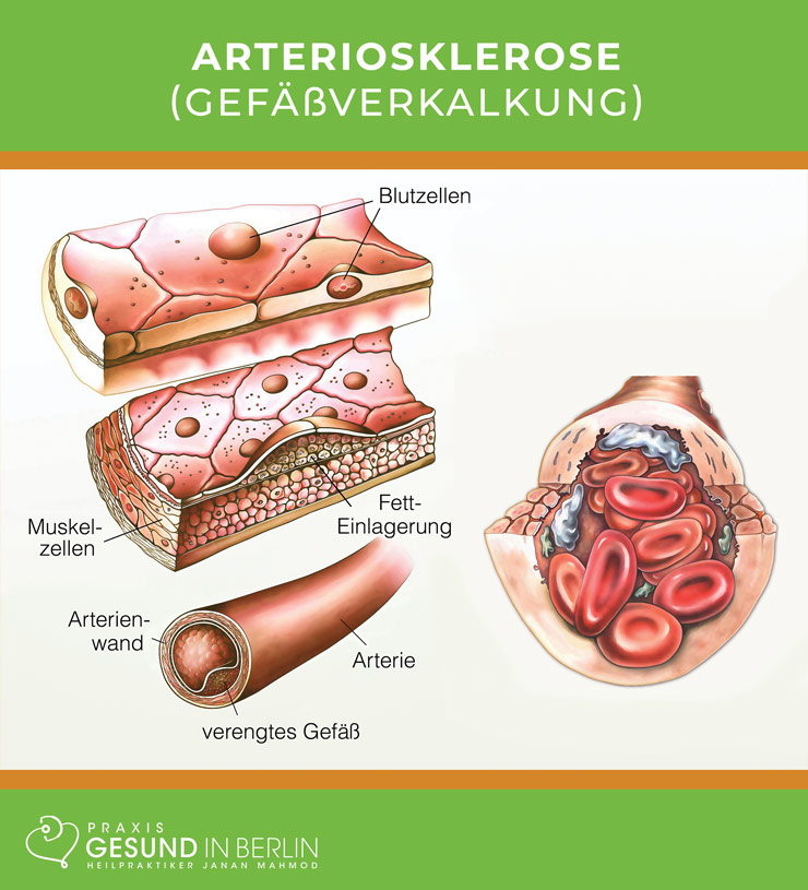 Arteriosklerose oder Gefäßverkalkung – Schaubild