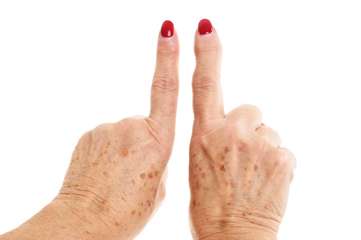 Arthritis in Finger- und Handgelenke