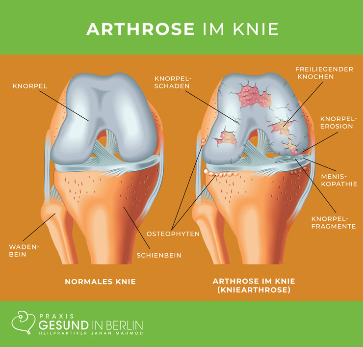 Arthrose im Knie – Schaubild