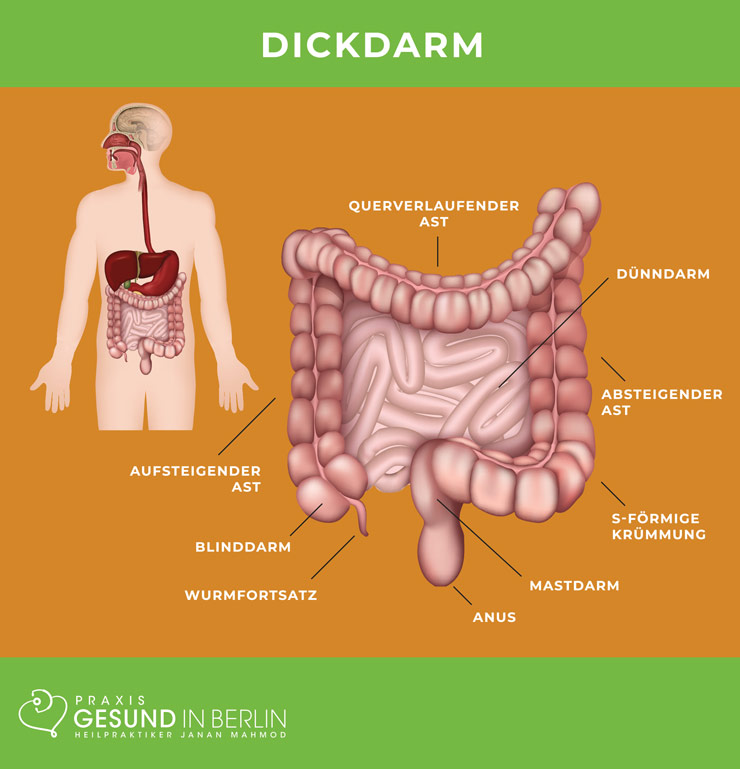 Entzündung des Dickdarms bei Colitis ulcerosa Bei der Colitis ulcerosa beschränkt sich die Entzündung auf den Dickdarm