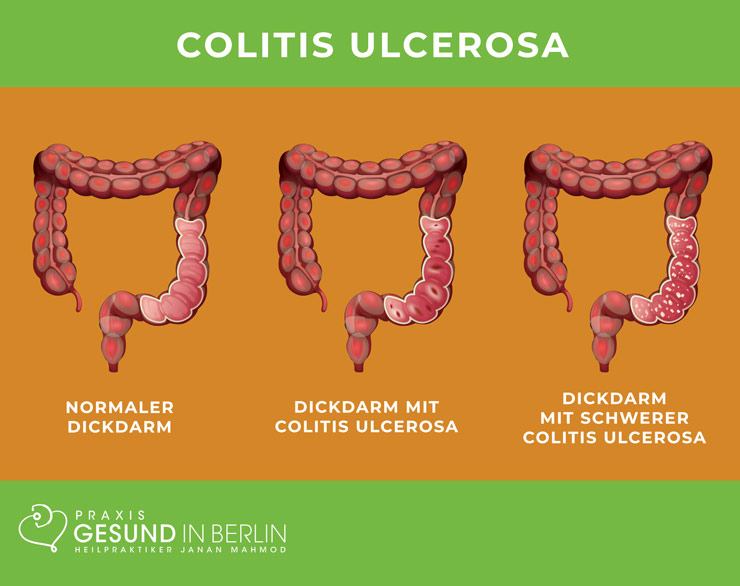 Colitis ulcerosa – Schaubild