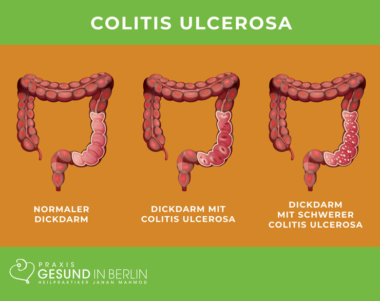 Colitis ulcerosa – Schaubild Colitis ulcerosa – Schaubild