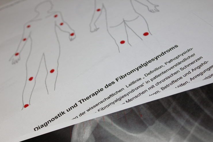 Fibromyalgie Diagnose Fibromyalgie Diagnose