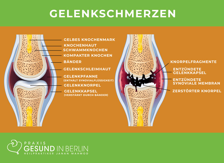 Gelenkschmerzen – Schaubild Gelenkschmerzen – Schaubild
