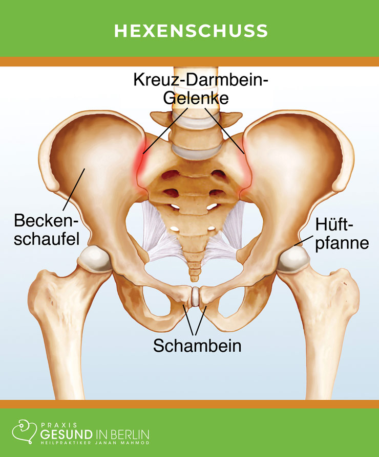 Hexenschuss – Schaubild