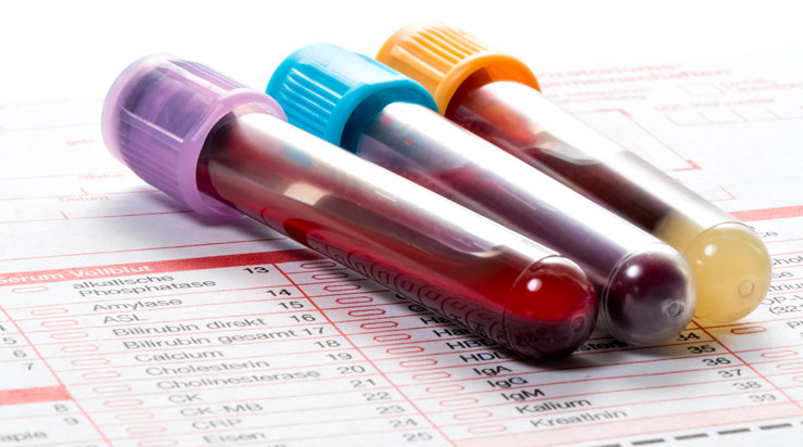 Bild von Blutproben für die Labordiagnostik