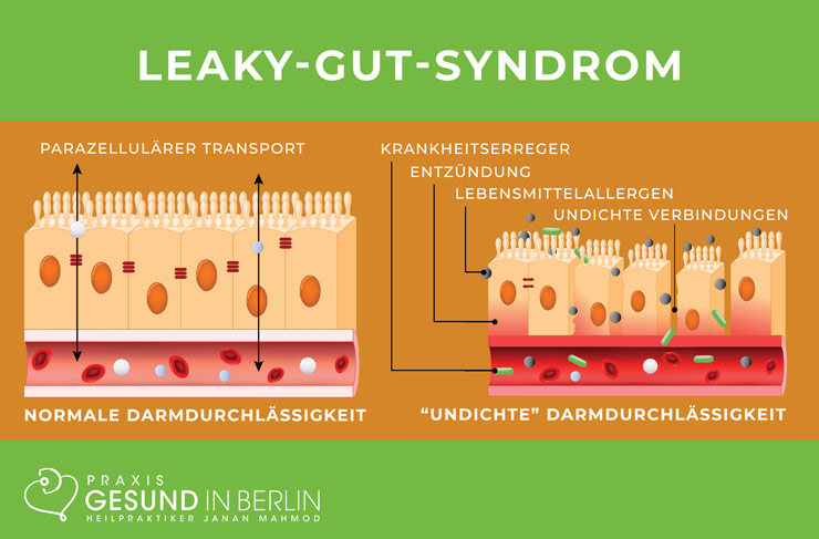 Leaky-Gut-Syndrom – Schaubild Leaky-Gut-Syndrom – Schaubild