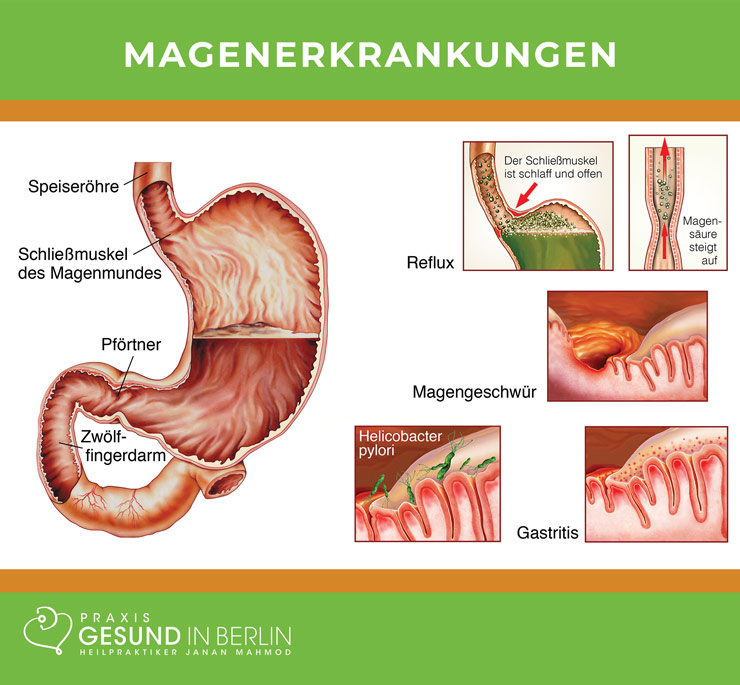 Magenerkrankungen – Schaubild Magenerkrankungen – Schaubild