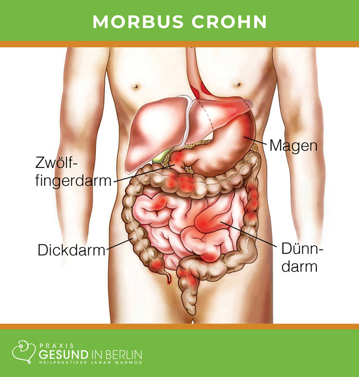 Morbus Crohn