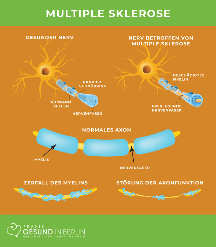 Multiple Sklerose – Schaubild