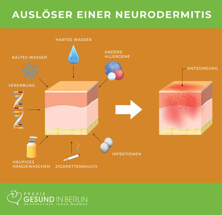 Ursachen und Auslöser einer Neurodermitis