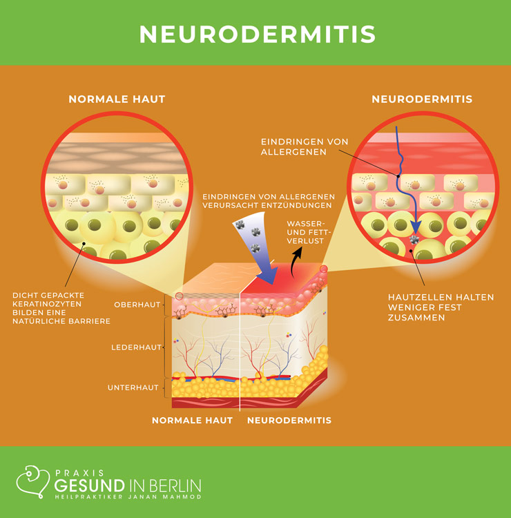 Neurodermitis – Schaubild