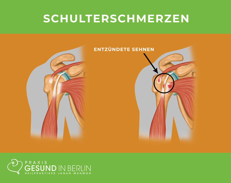 Schulterschmerzen – Schaubild