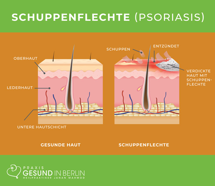 Schuppenflechte (Psoriasis) – Schaubild Schuppenflechte (Psoriasis) – Schaubild