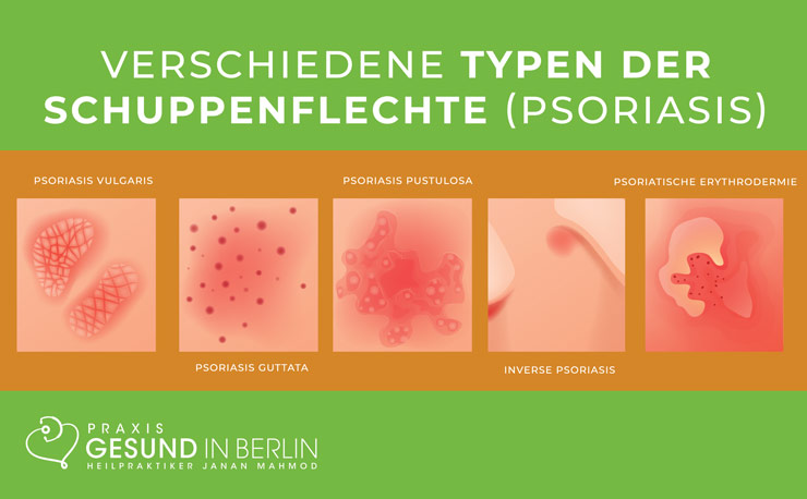 Typen der Schuppenflechte Typen der Schuppenflechte