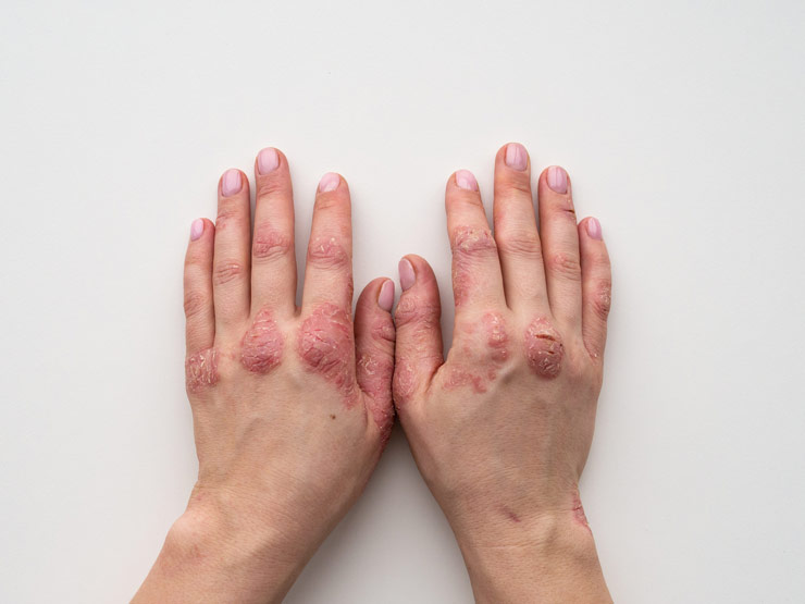 Schuppenflechte-Psoriasis Schuppenflechte-Psoriasis
