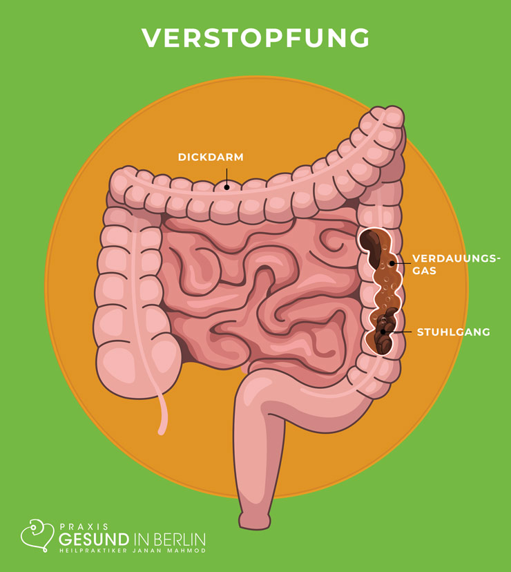 Verstopfung – Schaubild