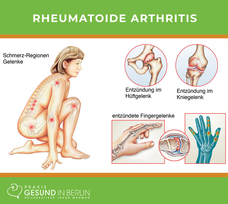 Rheumatoide Arthritis – Schaubild