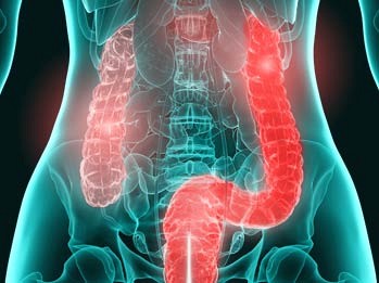 Colitis ulcerosa